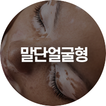 말단얼굴형