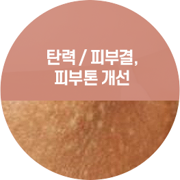 홍조 / 혈관성 색소치료